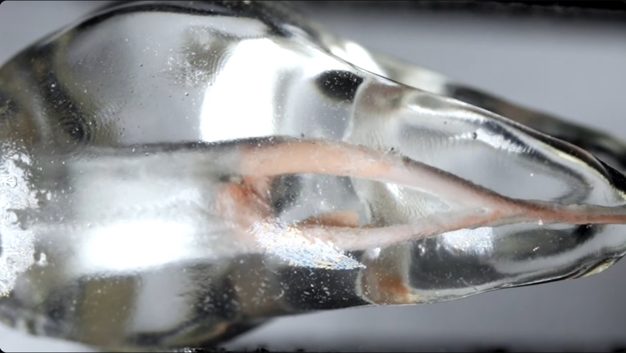 Endodontic Retreament with ZenFlex RT. Crown Down Brushing,