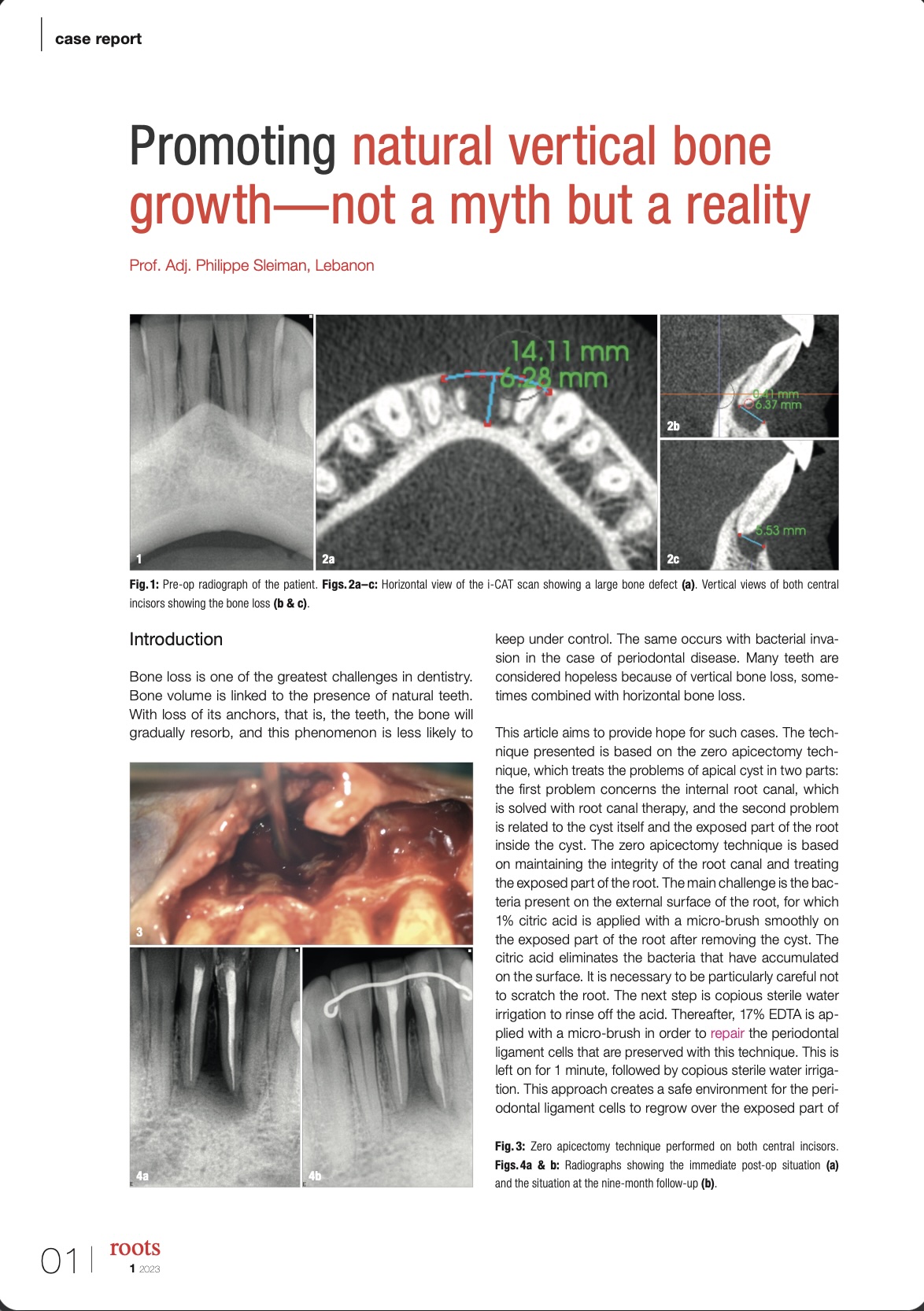 Promoting natural vertical bone growth—not a myth but a reality