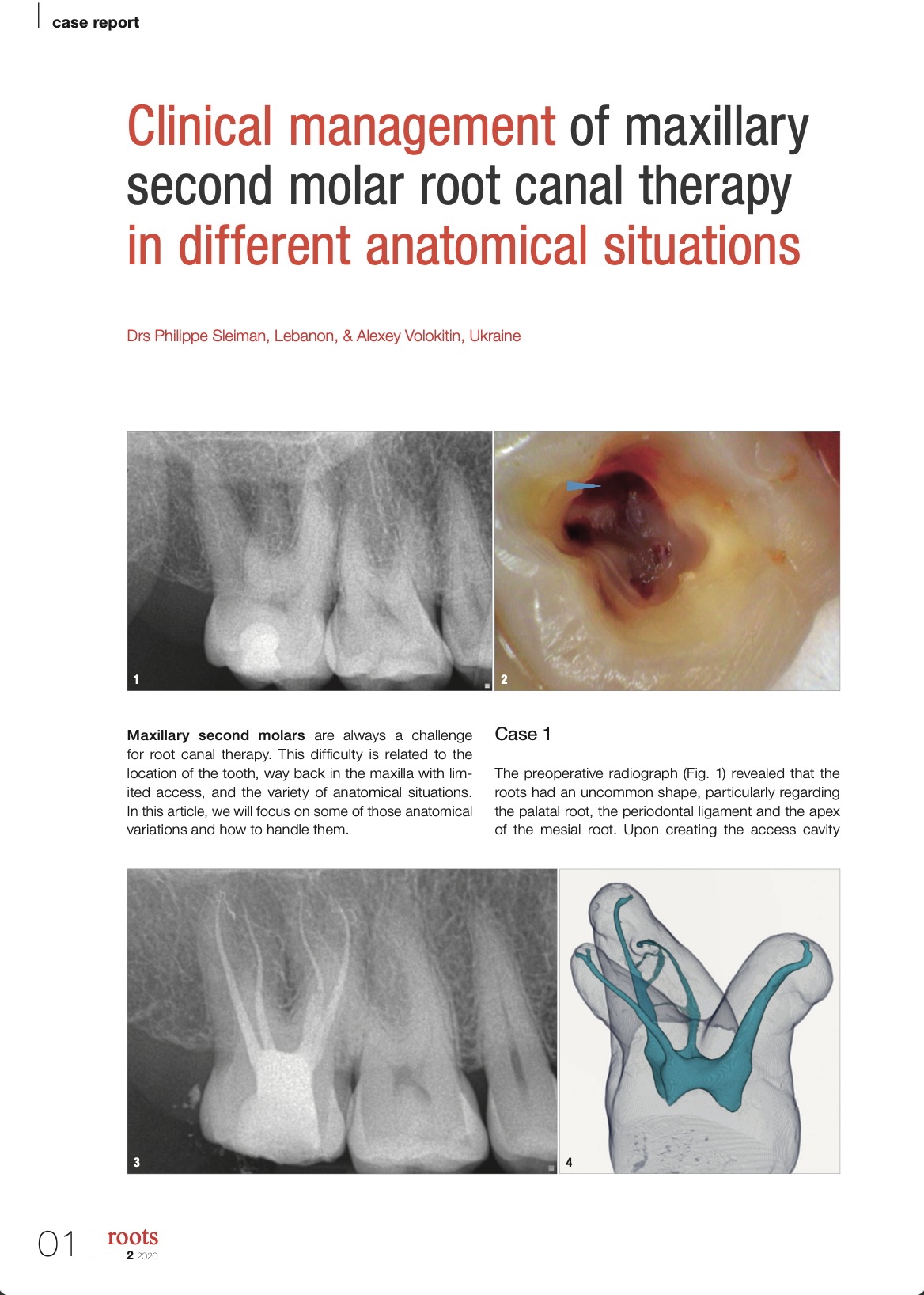 Clinical management of maxillary second molar root canal therapy in different anatomical situations