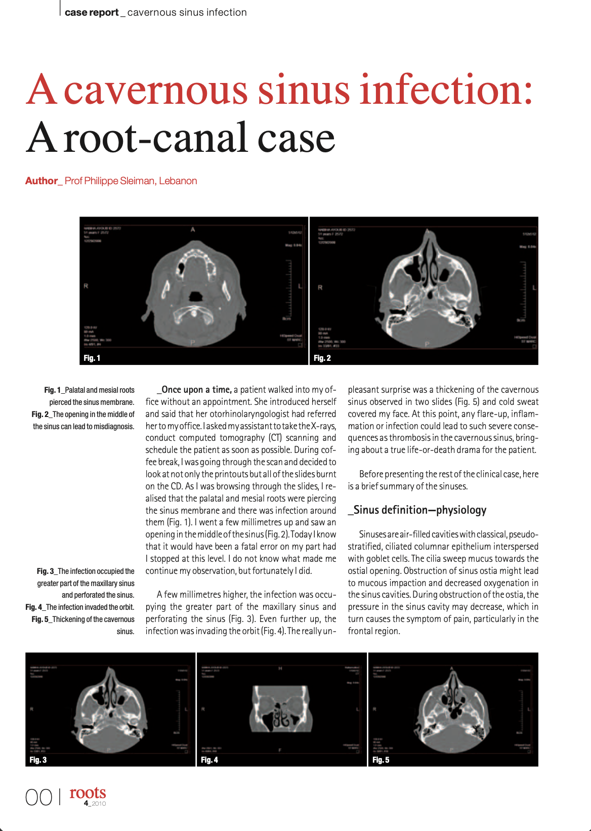 A cavernous sinus infection: A root-canal case