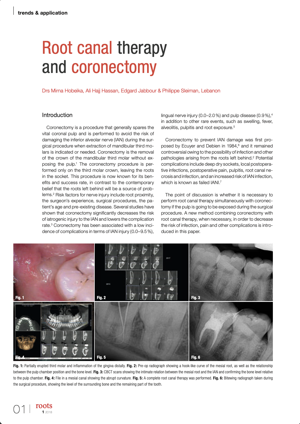 Root canal therapy and coronectomy