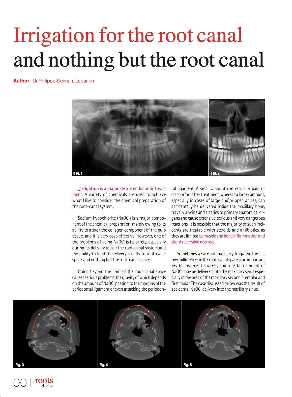 Irrigation for the root canal and nothing but the root canal