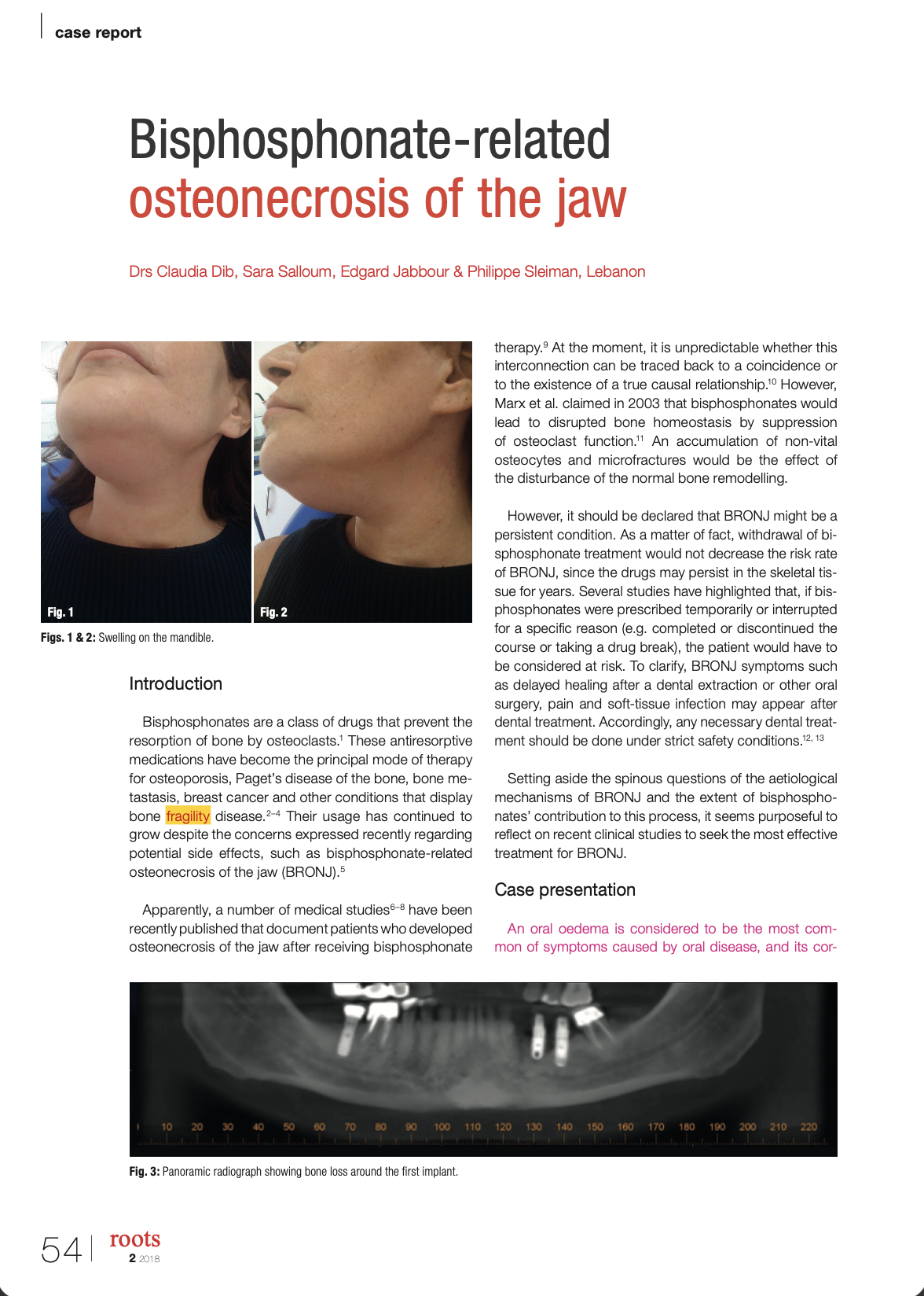 Bisphosphonate-related osteonecrosis of the jaw