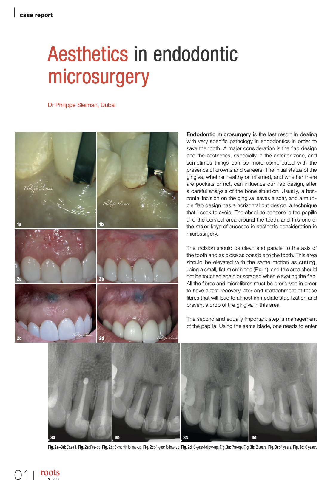 Aesthetics in endodontic microsurgery