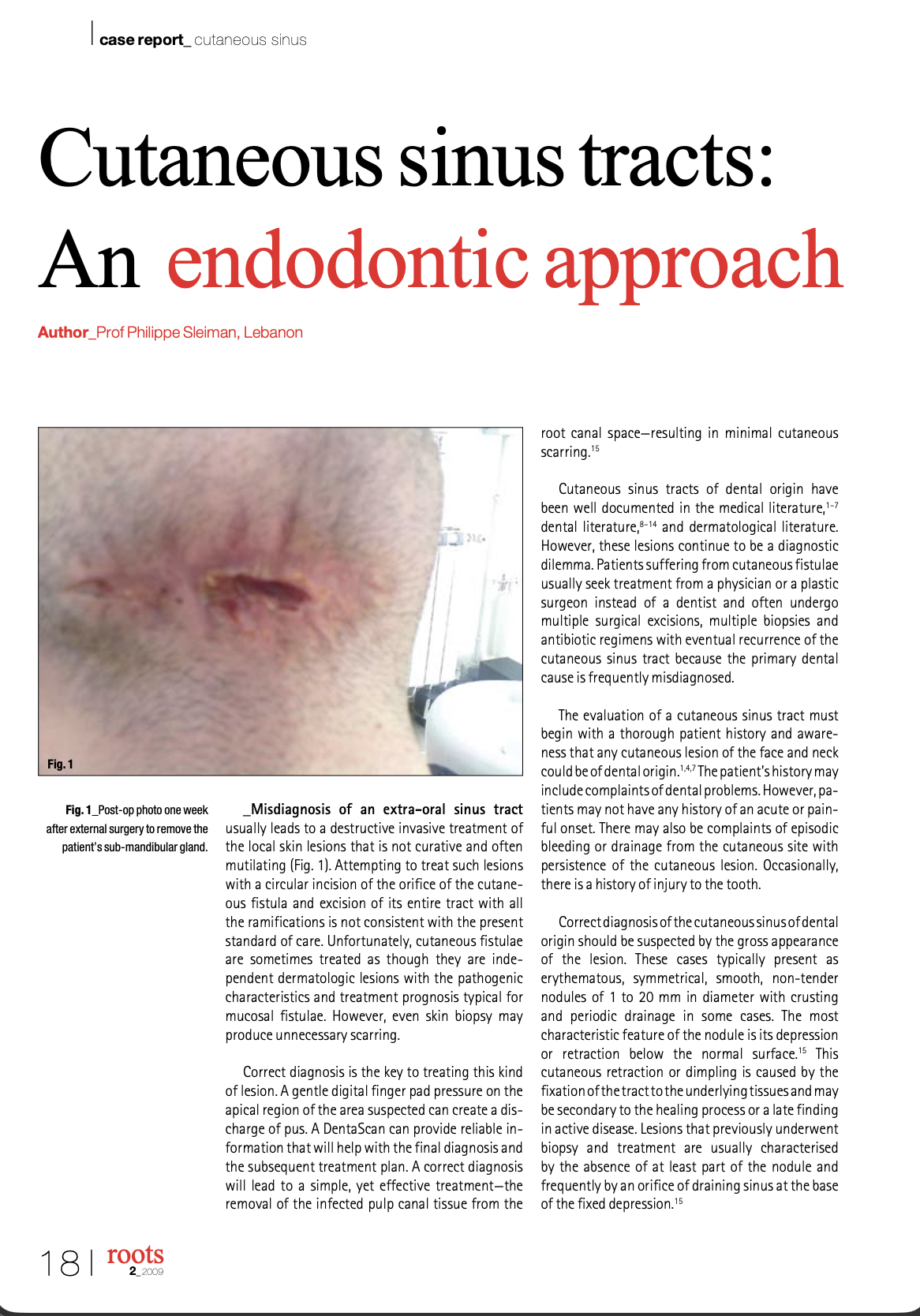 Cutaneous sinus tracts: An endodontic approach