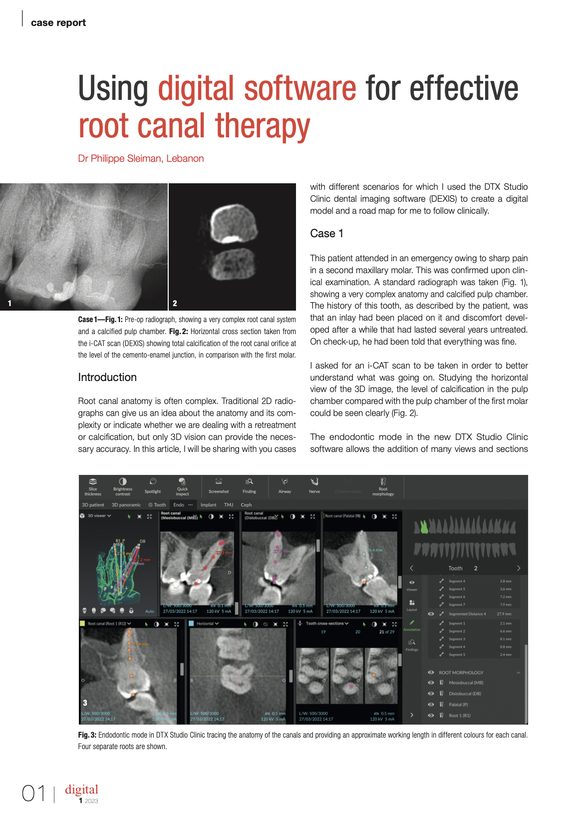 Using digital software for effective root canal therapy