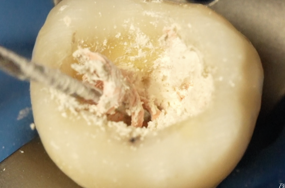 Root canal retreatment with ZenFlex RT. Soften and drag