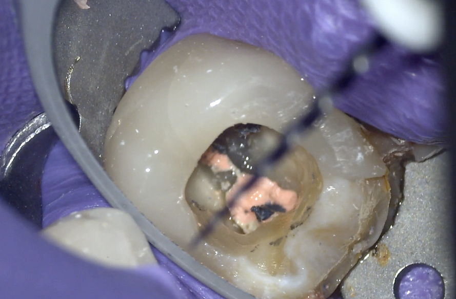 Endodontic root canal retreatment with ZenFlex RT to remove thermafil plastic carrier obturator