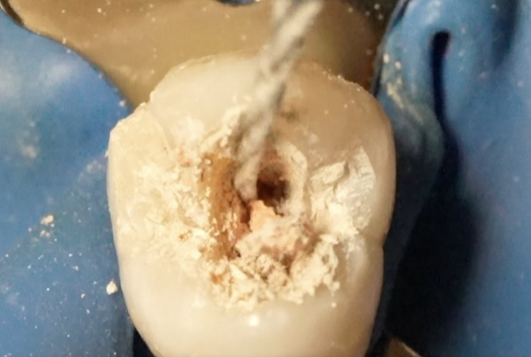 Endodontic retreatment. Crown Down Brushing