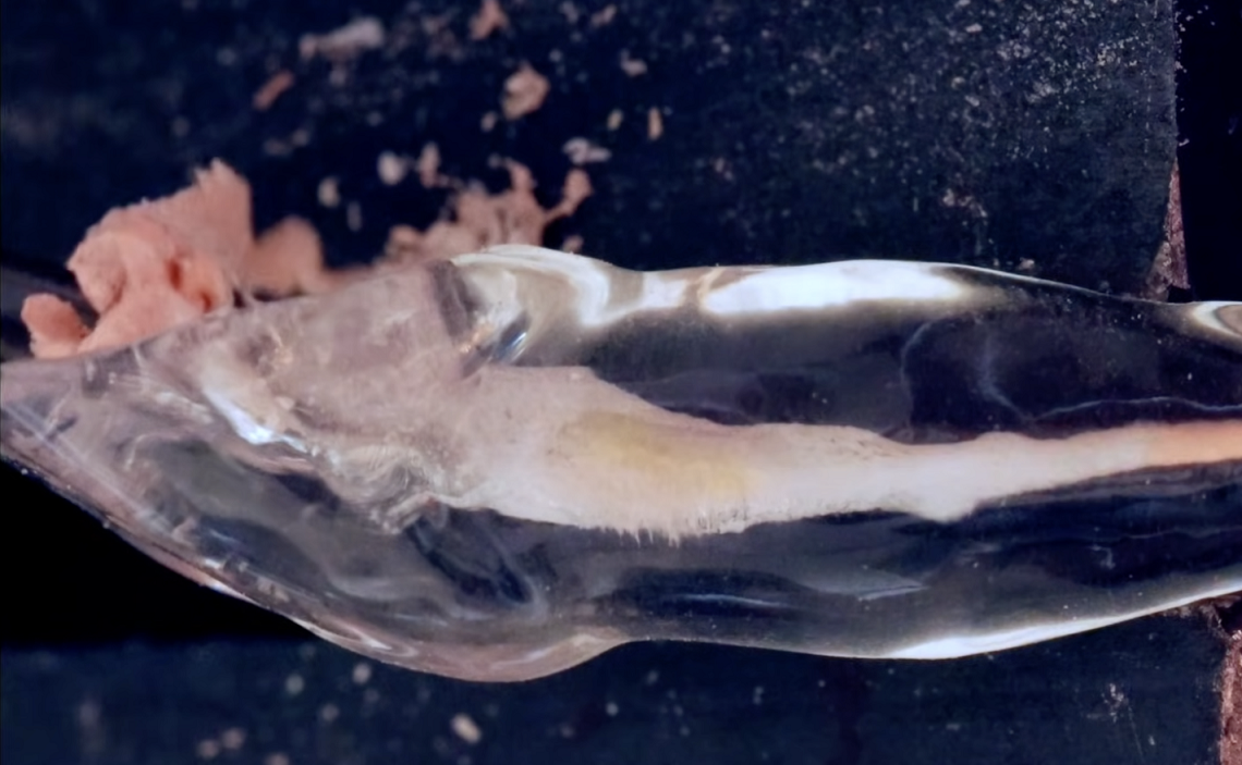 Endodontic retreatment using ZenFlex RT full sequence.